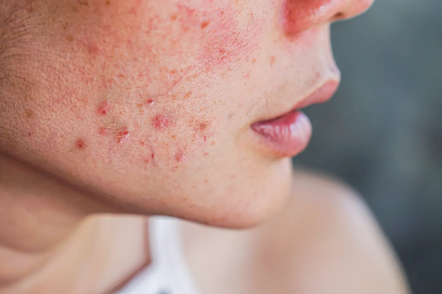 Acne Treatment